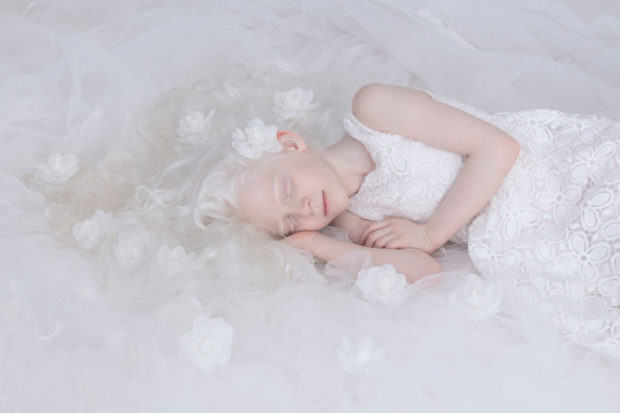 albinos_4